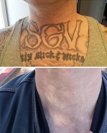 Before laser tattoo removal progress photo in Las Vegas