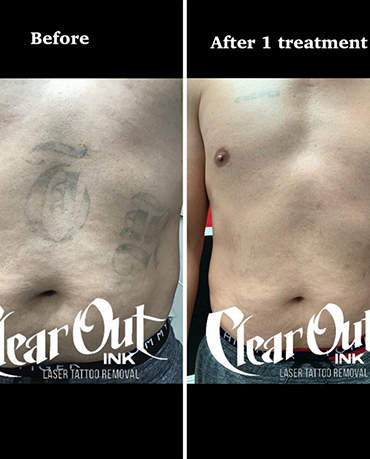 Before laser tattoo removal progress photo in Las Vegas