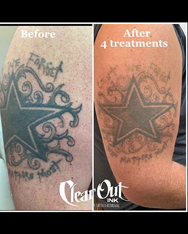 After laser tattoo removal progress photo in Las Vegas