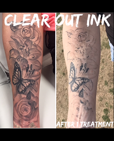 Before laser tattoo removal progress photo in Las Vegas