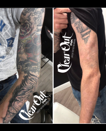 Before laser tattoo removal progress photo in Las Vegas