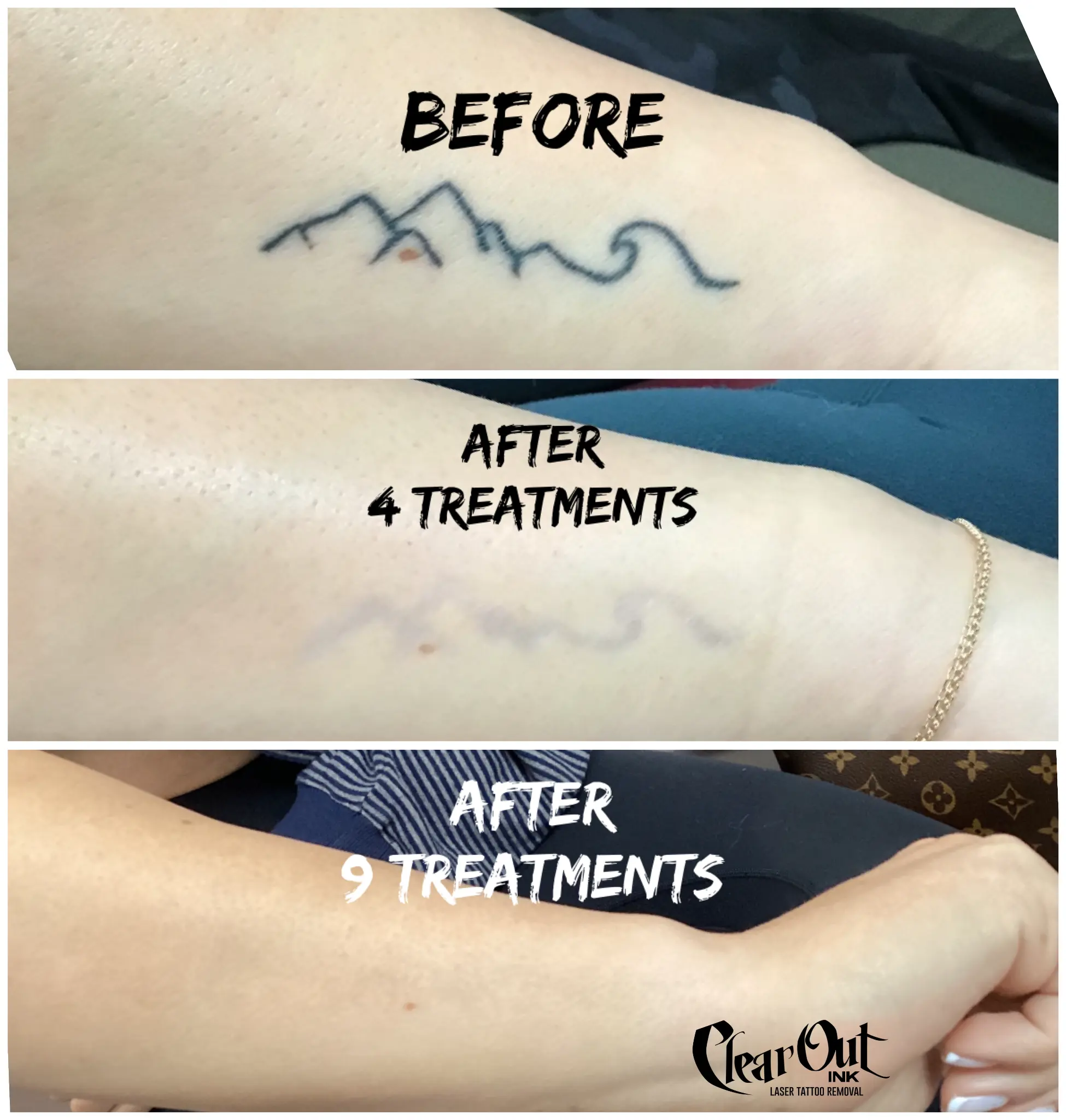 After laser tattoo removal progress photo in Las Vegas