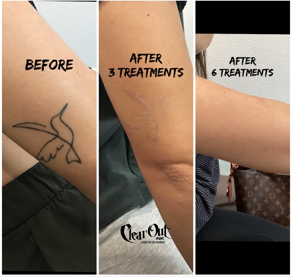 After laser tattoo removal progress photo in Las Vegas