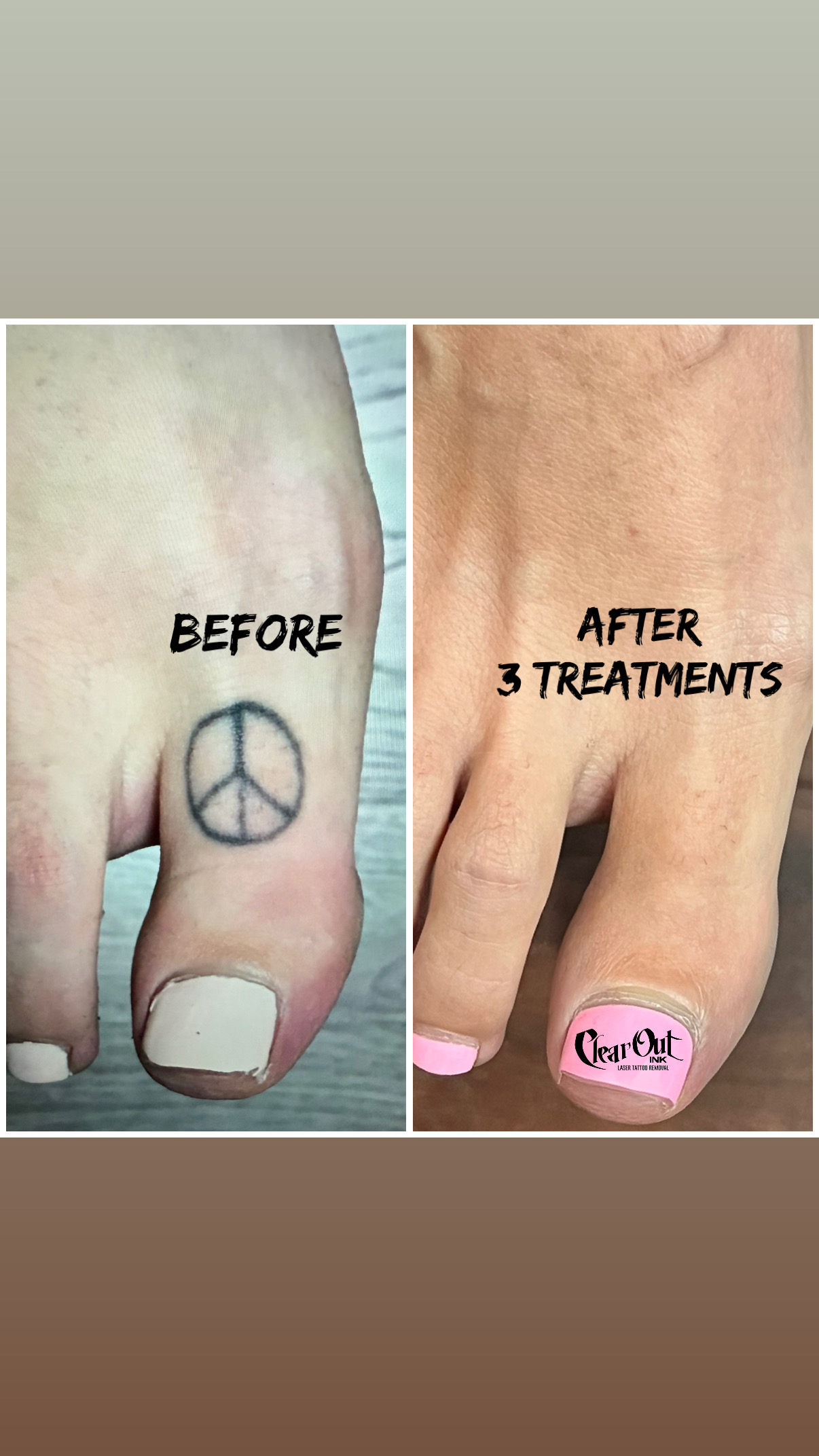 After laser tattoo removal progress photo in Las Vegas