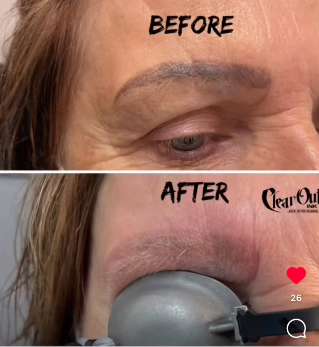 After laser tattoo removal progress photo in Las Vegas