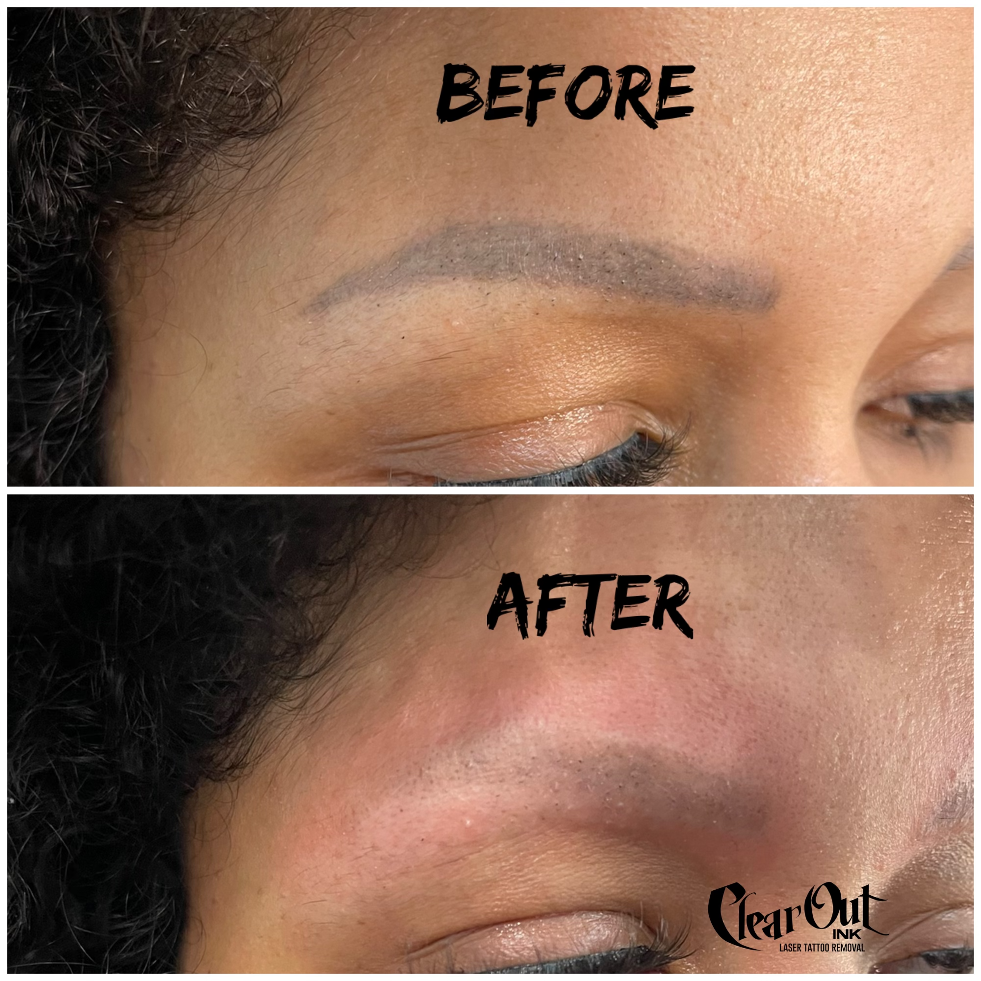Before laser tattoo removal progress photo in Las Vegas