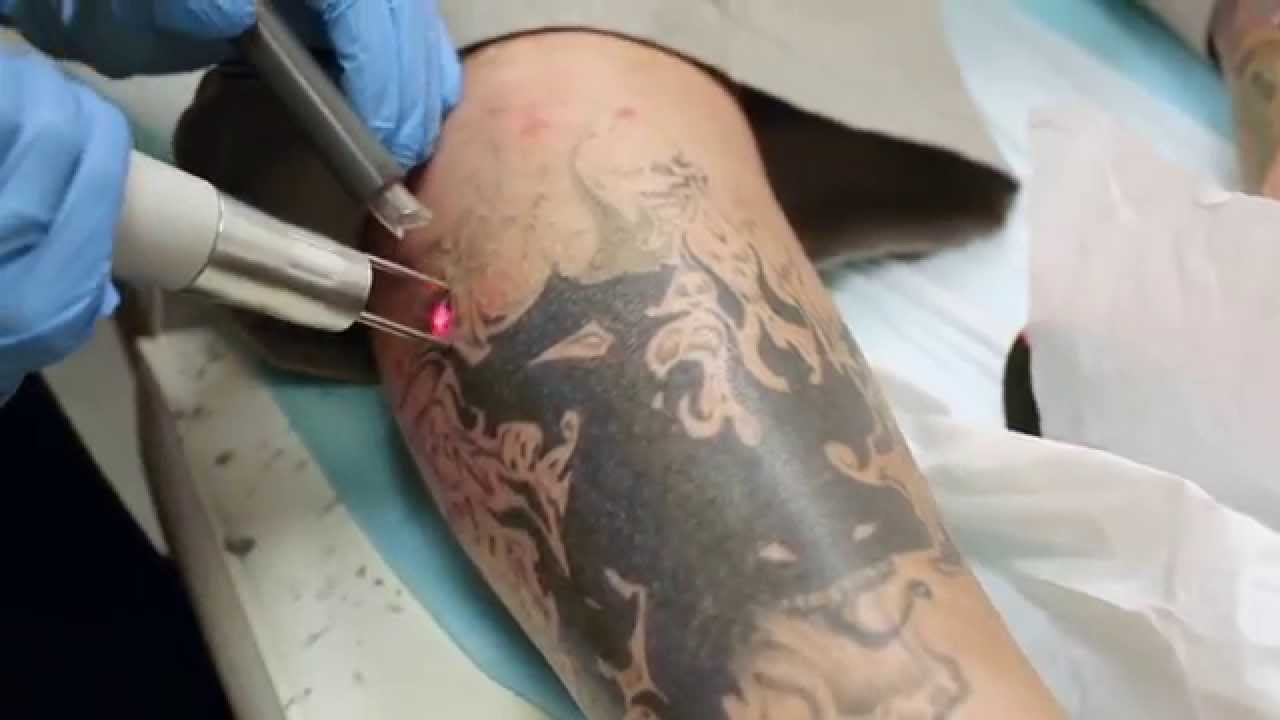 Best Las Vegas Tattoo Removal Clear Out Ink Laser Tattoo