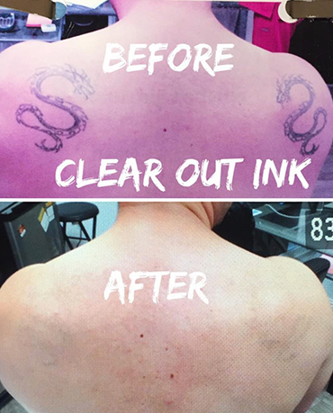 Clear Out Ink Laser Tattoo Removal