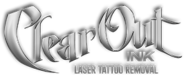 laser tattoo removal henderson