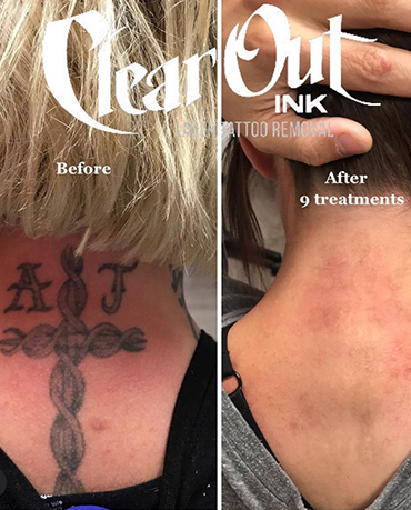 Laser Tattoo Removal Las Vegas