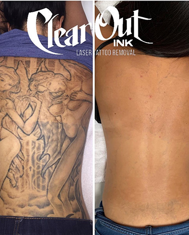 Laser Tattoo Removal