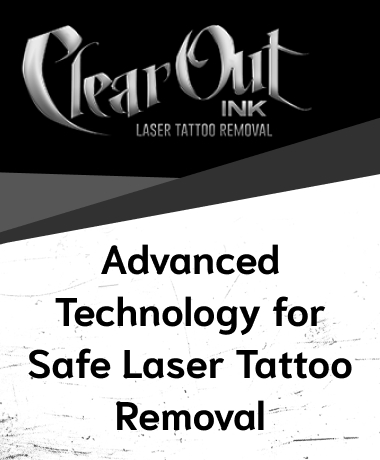 Laser Tattoo Removal in Las Vegas