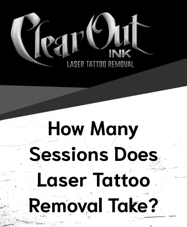 Tattoo Removal Las vegas