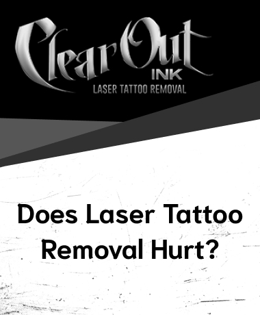 Tattoo Removal in Las Vegas