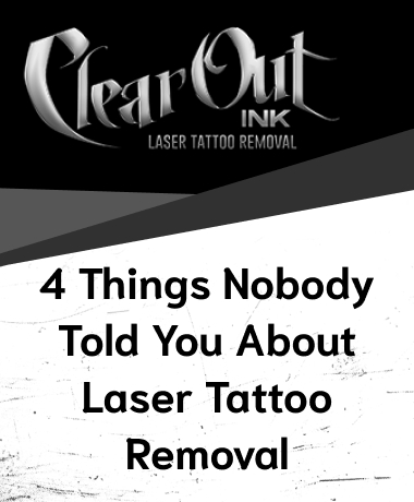 Laser Tattoo Removal in Las Vegas