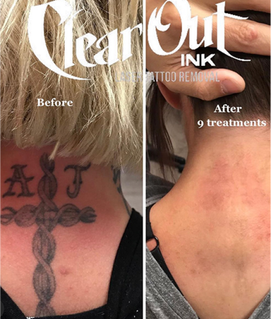 Tattoo Removal | Costs, Risks and Considerations | Costhetics