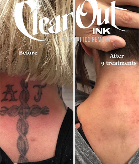 Tattoo Removal Las Vegas