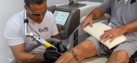 Laser Tattoo Removal Las Vegas