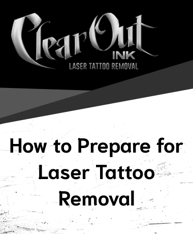 Laser Tattoo Removal in Las Vegas