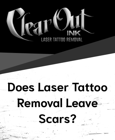 Laser Tattoo Removal in Las Vegas