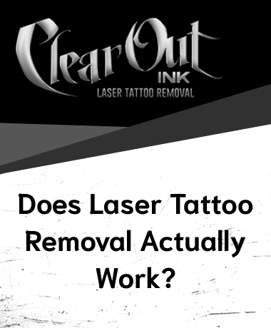 Tattoo Removal in Las Vegas